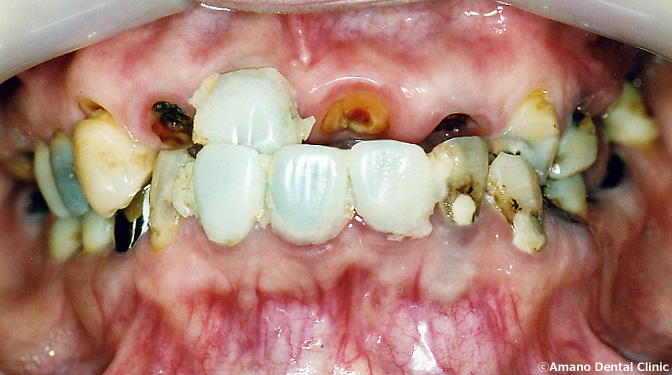 ひどい虫歯の痛くない治療法、ひどい虫歯の治療例